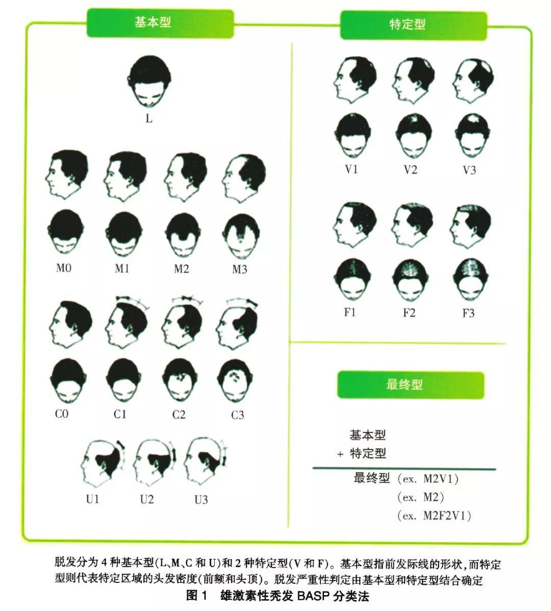 防脱防秃实用指南 雄激素性脱发分类与程度